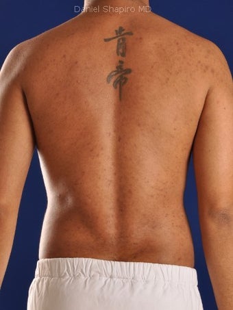 Vaser Hi Def Liposuction of the abdomen, chest, back, and flanks with fat injections to the pectoralis region