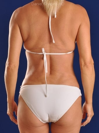 Vaser Hi-Def Liposuction of abdomen, chest, back and flanks