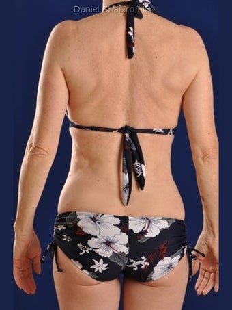 Vaser Hi Def Liposuction of chest, abdomen, back and flanks