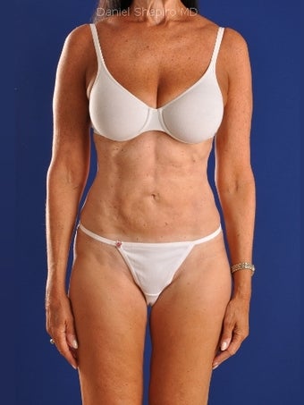 Vaser Hi Def Liposuction of abdomen, thighs, flanks and back with fat injections to buttocks