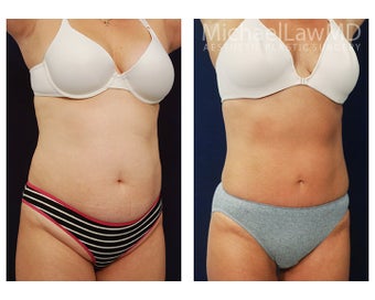 Liposuction