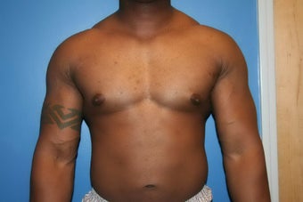VASER Liposuction for gynecomastia