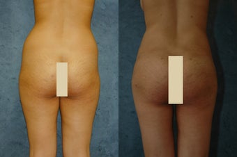 VASER Liposuction