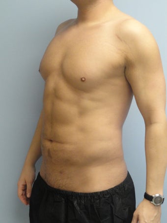 VASER Liposuction (HiDef)