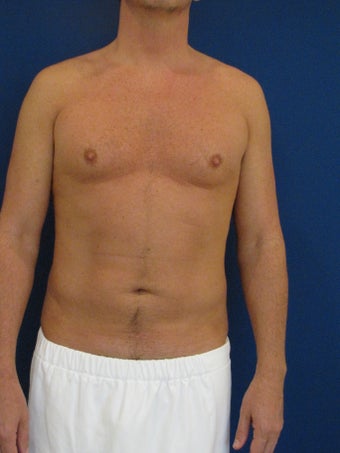 Vaser Hi Def Liposuction