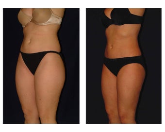 Liposuction