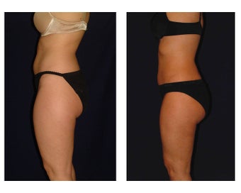 Liposuction