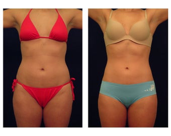 Liposuction