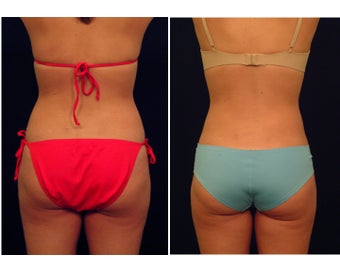 Liposuction