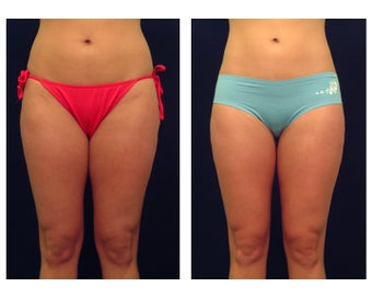 Liposuction