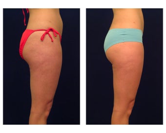 Liposuction