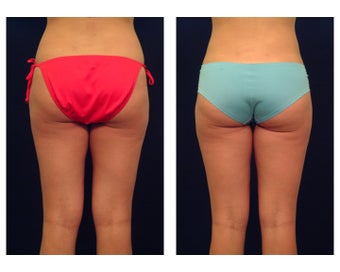 Liposuction