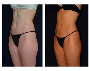 Liposuction