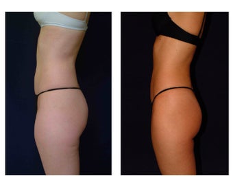 Liposuction