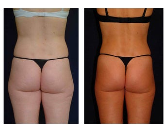 Liposuction