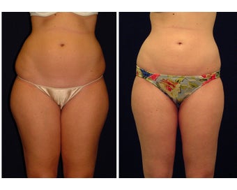 Liposuction
