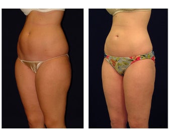Liposuction