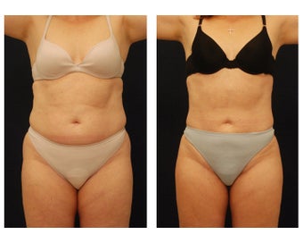 Liposuction