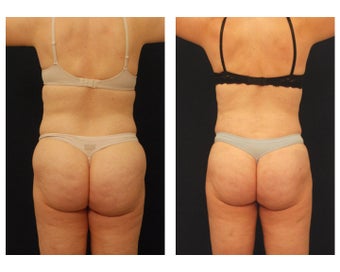 Liposuction