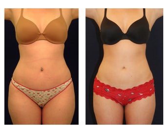 Liposuction