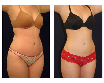 Liposuction