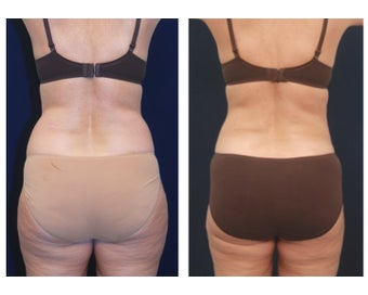 Liposuction