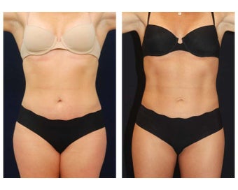 Liposuction