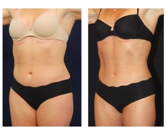 Liposuction