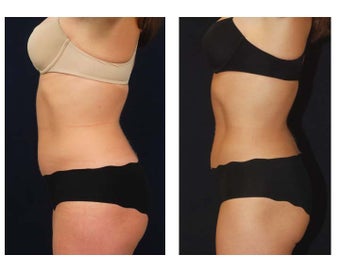Liposuction