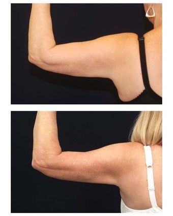 Liposuction