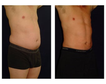 Liposuction