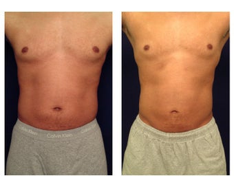 Liposuction