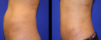 Vaser Liposuction