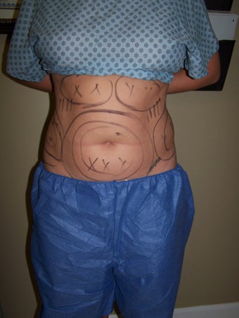 Vaser liposuction