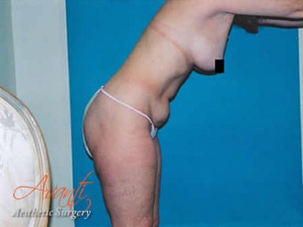 Vaser Lipo - Abdomen