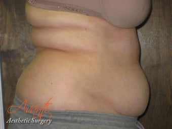 Vaser Lipo - Abdomen