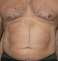VASER liposuction of abdominal wall