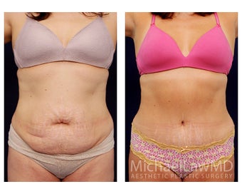 Tummy Tuck with Liposuction