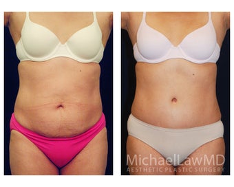 Tummy Tuck with Liposuction