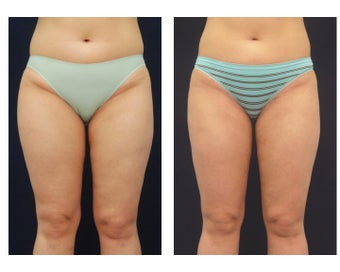 Liposuction