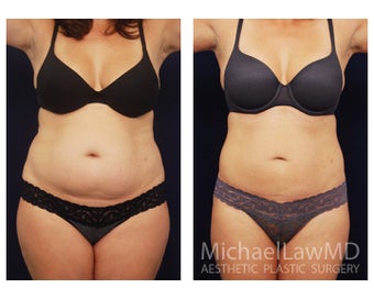 Liposuction
