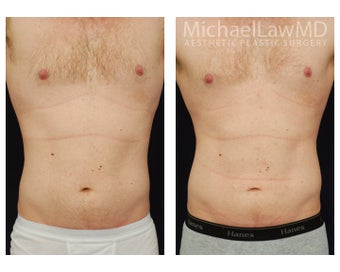 Liposuction