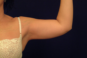 Liposuction