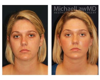 Chin Liposuction