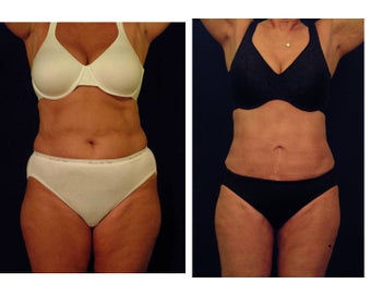 Liposuction