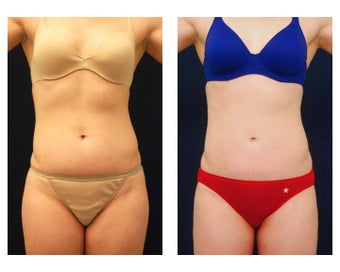 Liposuction