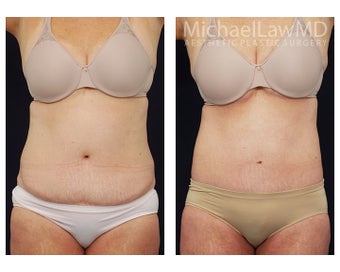 Liposuction