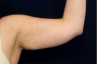 Liposuction