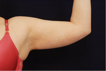 Liposuction