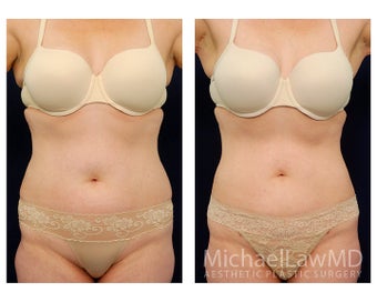 Liposuction